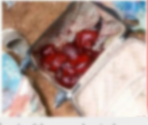 Trafic d’organes humains : Un individu arrêté en possession de poumons frais dans une valisette