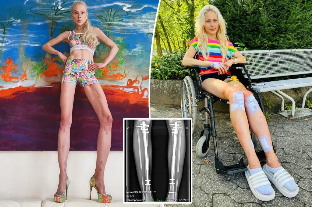A la quête de l&rsquo;idéal de beauté: Une mannequin se fait allonger les jambes de 14 cm  ‎