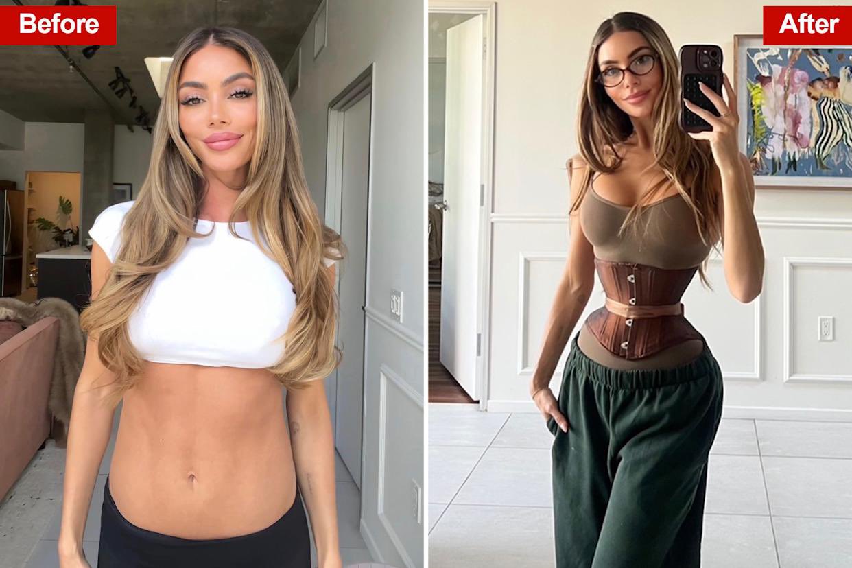 ‎« Je ne recommande cette chirurgie à personne »: une influenceuse retire 6 côtes pour modifier sa silhouette  ‎