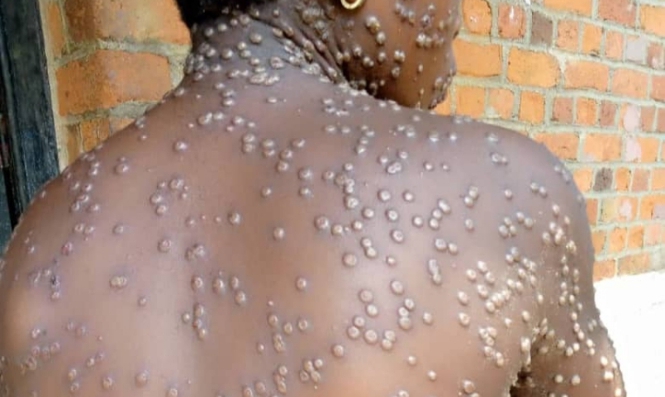 Variole simienne: Deux (2) cas enregistrés au Togo