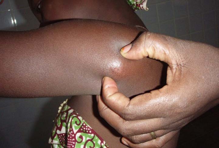 Ulcère de Buruli:  Une campagne gratuite pour soigner les plaies chroniques