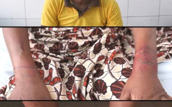 Torturée au feu à Ekpè : la victime raconte ce qu&rsquo;elle a subi  ‎