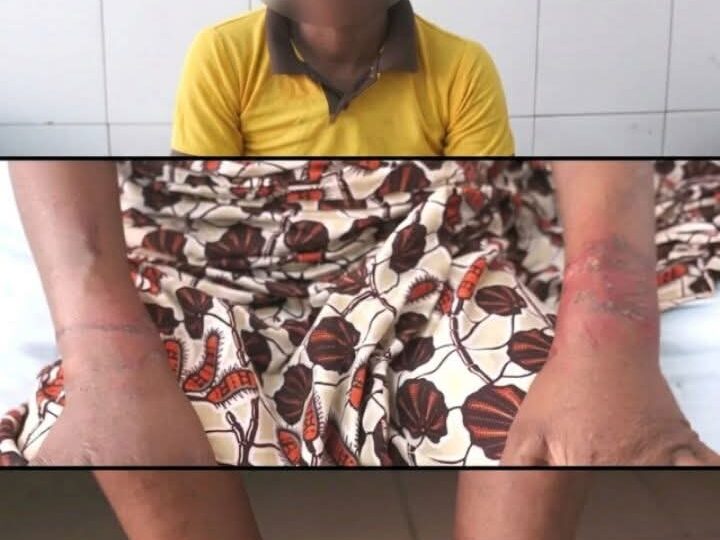 Torturée au feu à Ekpè : la victime raconte ce qu&rsquo;elle a subi  ‎