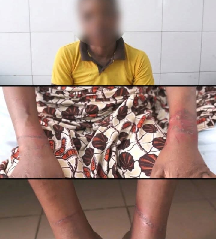 Torturée au feu à Ekpè : la victime raconte ce qu&rsquo;elle a subi  ‎